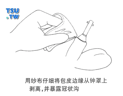 用纱布仔细将包皮边缘从钟罩上剥离,并暴露冠状沟