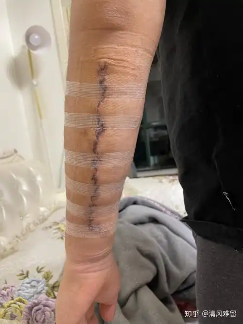 20厘米纹身切除及恢复日记3