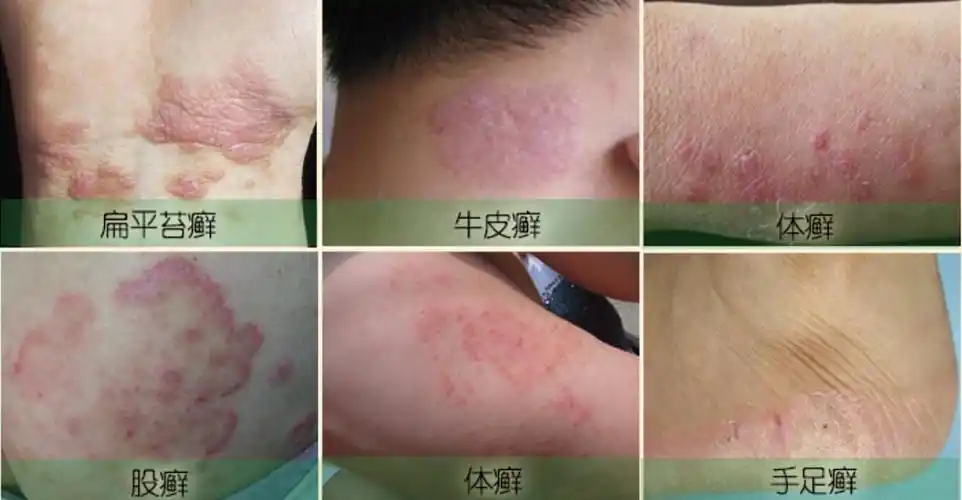 【长沙皮肤病医院科普】体癣与股癣的区别和治疗方法解析