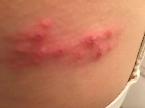 后背突然起了一片痘痘,请问这是怎么了?