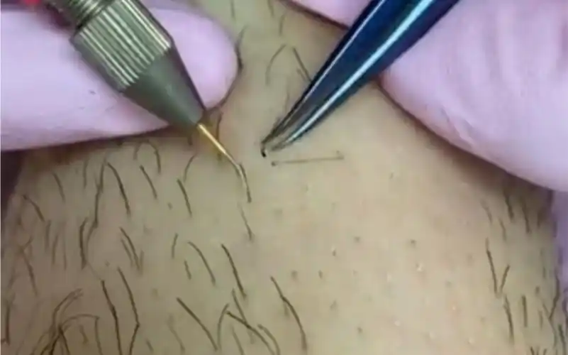 解压实验室看着挺疼的拔腿毛之前还要先往毛孔插上一针高科技工具除