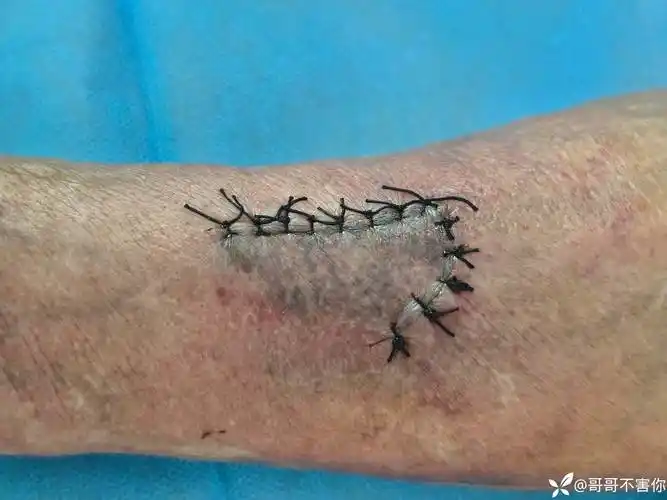 这个伤口皮肤会坏死吗?