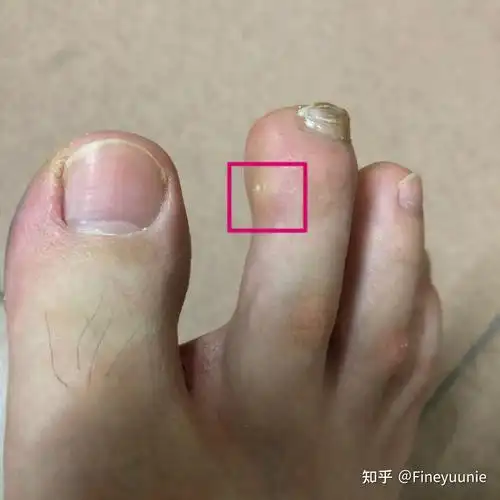 脚趾上长透明疙瘩中心点像针刺一样的形状