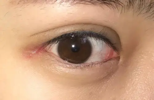 2: 依然是右眼问题 看上去比左眼疤痕严重多了 这样子的情况是不是