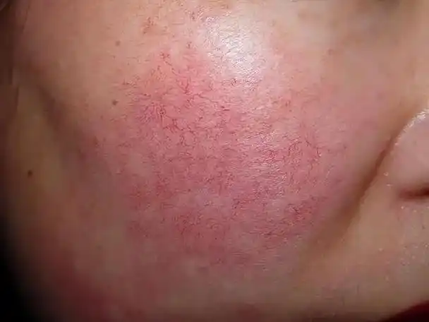 如何去除脸部红血丝?牢记以下7点,赶走难缠"红血丝"