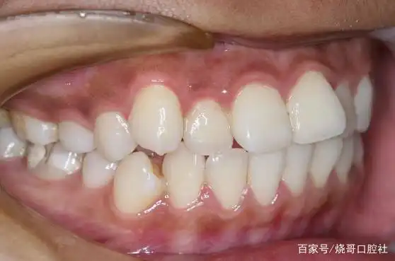 轻易拔除虎牙的危害是什么