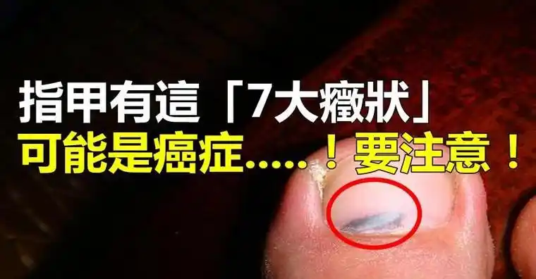 指甲有这「7大症状」是疾病预兆,尤其是这「黑色斑点」,可能是癌症.