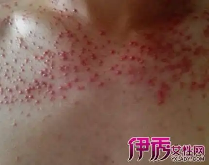 引起马拉色菌毛囊炎的原因 注意皮肤清洁