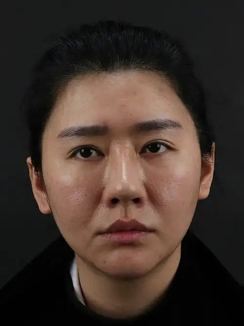 泪沟法令纹干纹细纹