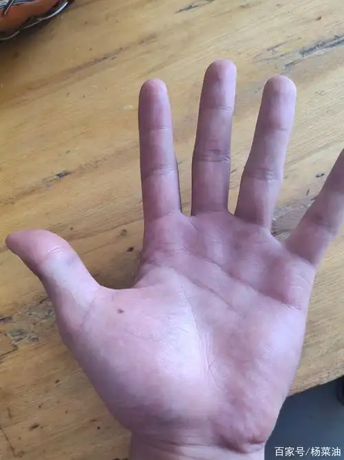 手掌为什么会突然长痣(手掌突然长了颗痣要紧吗)
