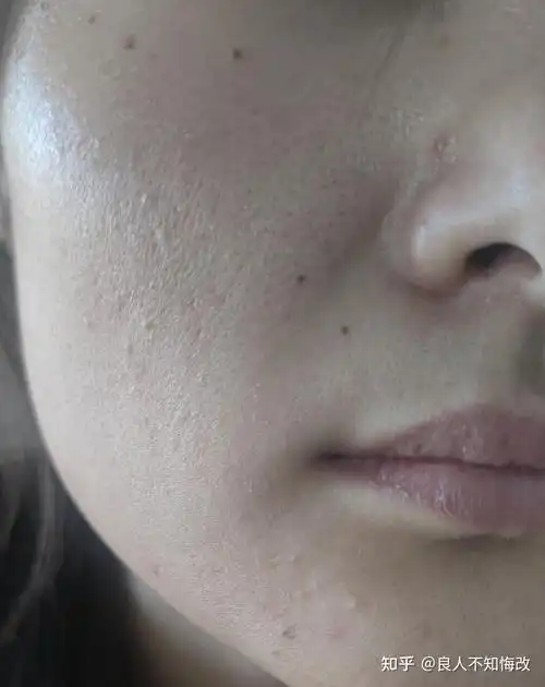 毛孔粗大还有毛发,还有救吗.