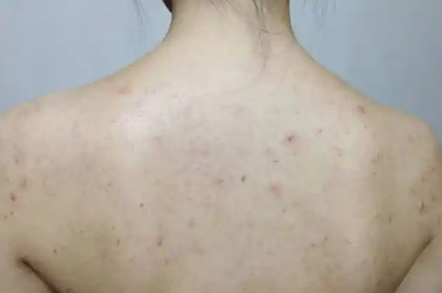 真皮与皮下组织构成 黑色素沉淀,肤色暗沉无光,手感粗糙 皮肤敏感开裂