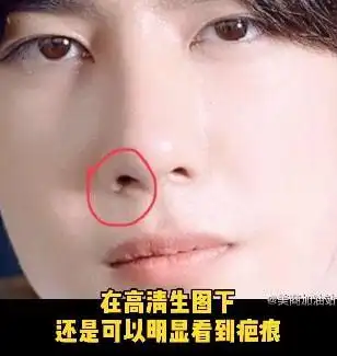 王一博鼻子疤痕又暴露了之前广告就被质疑不知是卡粉还是伤疤