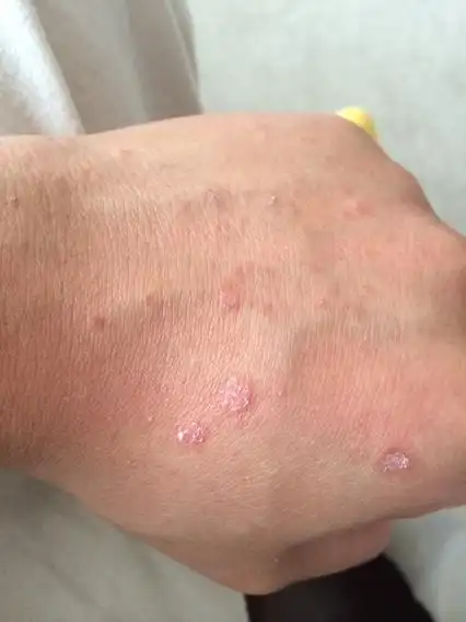 请问下这是梅毒的症状嘛?