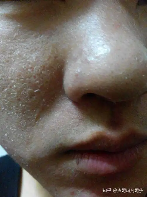 这是普通的面部起皮吗? - 知乎