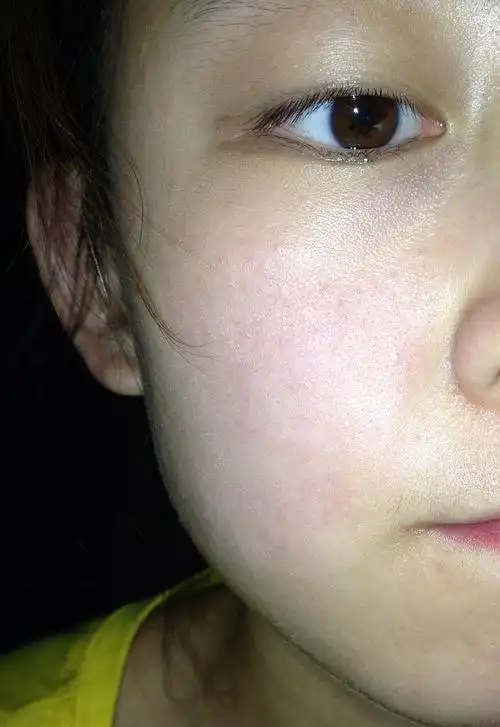 角质层薄,然后还很容易红,有时候会痒.毛孔也有变大的趋势!怎么办!