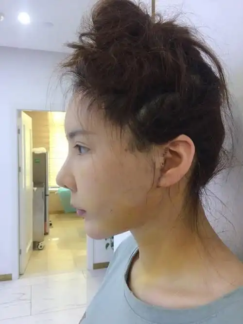 小切口迷你拉皮提升手术术后第六天