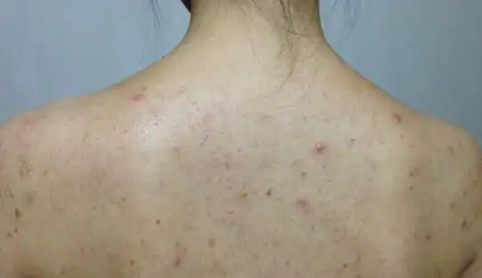 1,背部的皮质比较后背部角质层是特别厚的原因是因为新陈代谢是非常慢