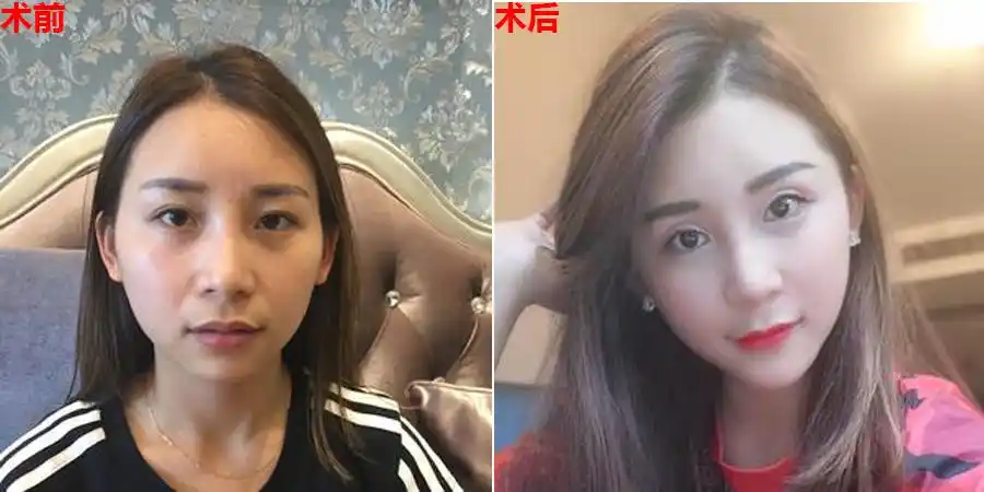 美熹真实案例假体垫下巴