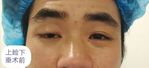 成年人的单眼先天性上睑下垂一例