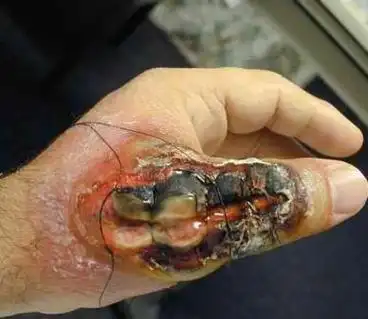 惨不忍睹!被毒蜘蛛咬过之后