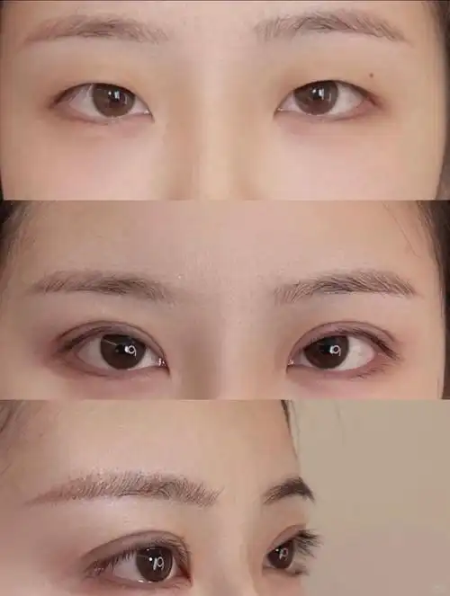 颜值新篇章:单眼皮到双眼皮的华丽蜕变!