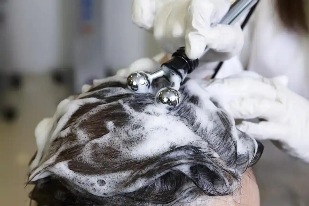 抗痘青年人(五)——为什么我们头皮也会长痘?