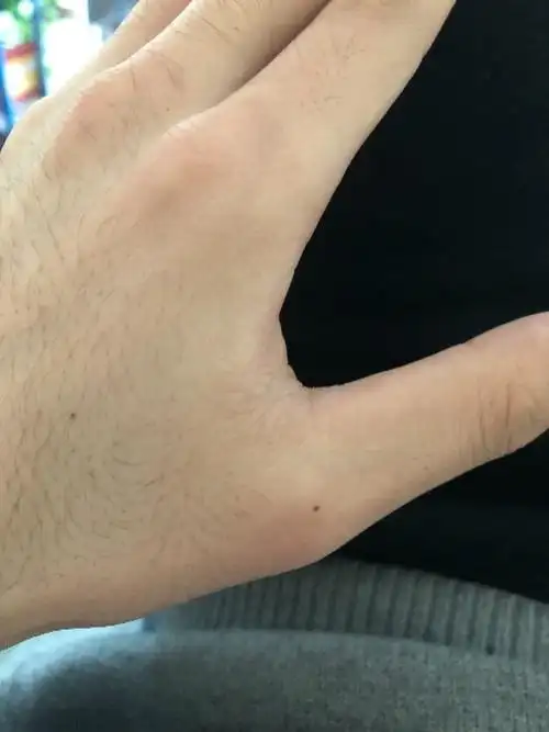 左手拇指长痣,位置如下图