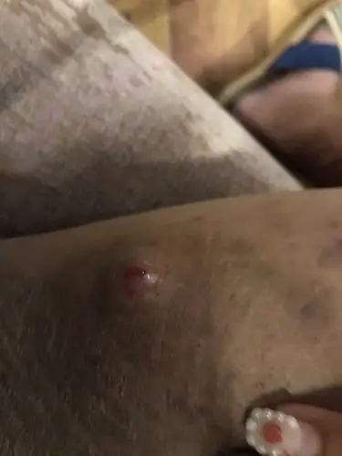 大腿根部长大包