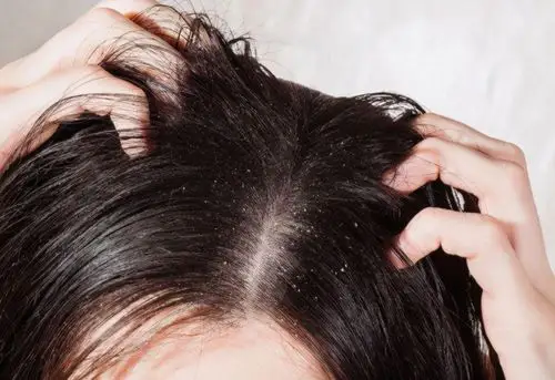 教你2种方法加2种植物,恢复头皮舒适干爽