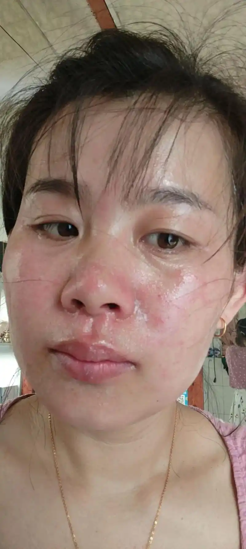 以前皮肤过敏,每次换季就过敏,用了好多膏药,化妆品,五年了, - 抖音