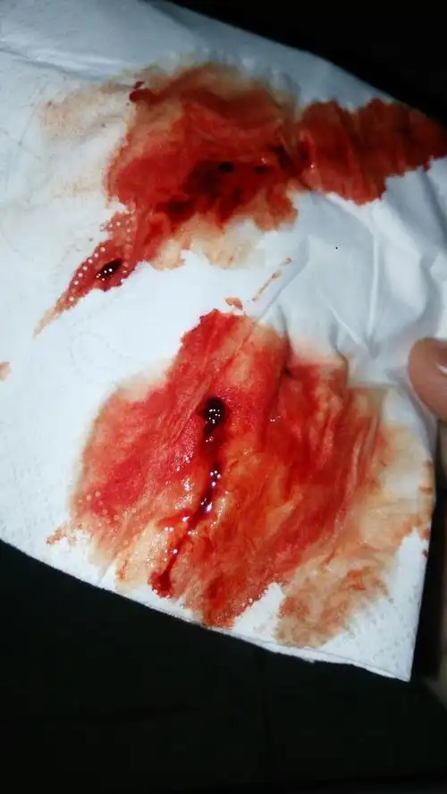 月经期排除一血块 看的我有点害怕 快完了 血很红 不像来姨妈 不知道