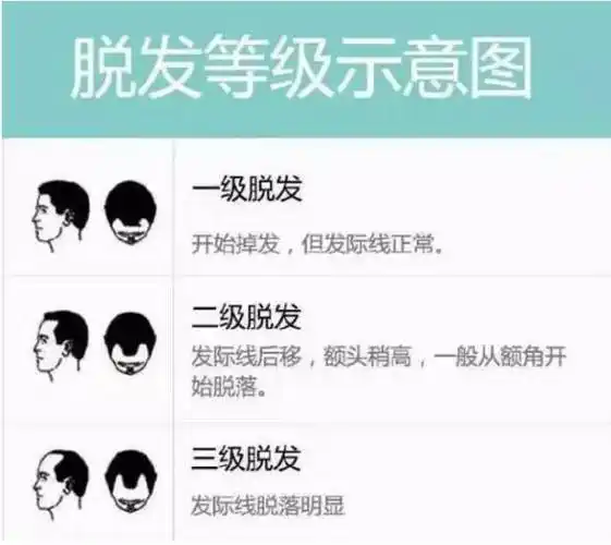 脱发等级对照图,看看你到几级了?