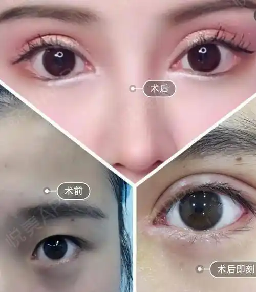 整容改变人生眼综合手术案例