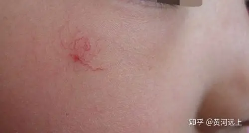 面部红血丝的成因及防治手段