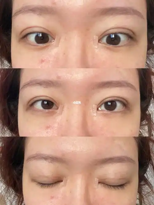 肿眼泡  #三点定位韩式双眼皮  #双眼皮  #双眼皮恢复  #苹果前置