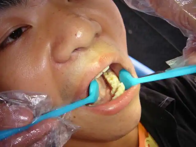 【交流】多生下颌双尖牙