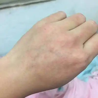 就只有手背上有,其他部位没有