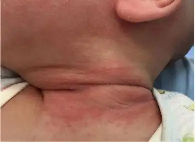 脂溢性皮炎的鉴别诊断