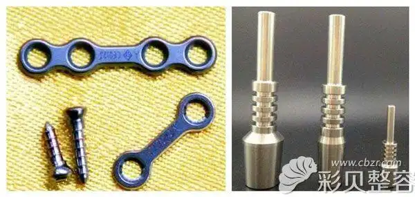 钛板钛钉固定是否安全呢