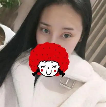 让我们一起欣赏这种微妙而自然的整形改变,埋线双眼皮恢复过程超详细