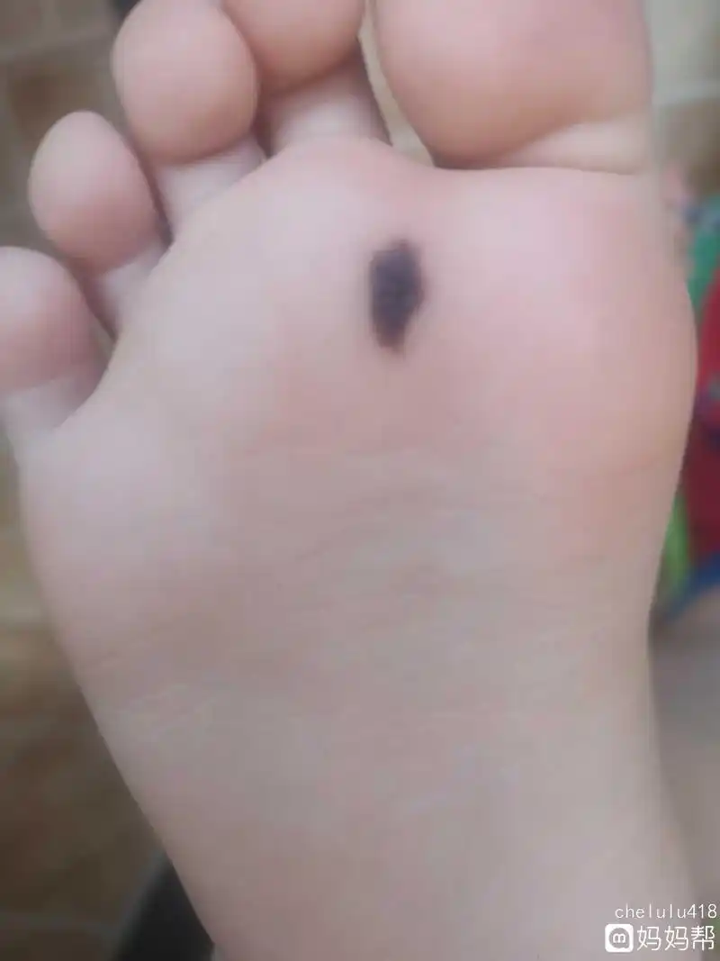 有没有孩子脚底有黑痣的 生下来一点点褐色