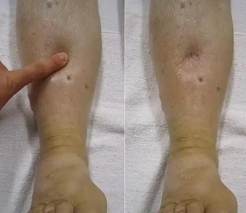 全身浮肿也是尿毒症常见的早期症状,不过一开始仅有足踝部和眼睑浮肿