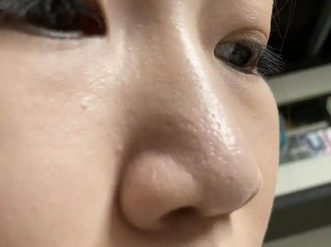 鼻子毛孔粗大怎么办