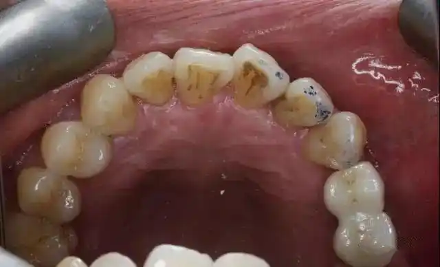 两颗种植牙种歪的病例补救