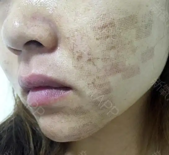 术后第四天被仪器打过的皮肤都已经结痂了,做完这个医_圈子-新氧美容