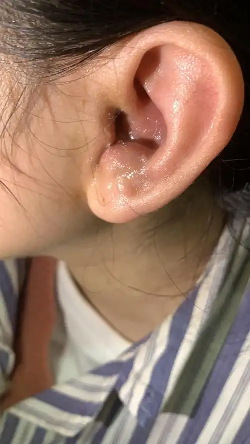 双侧耳廓红肿2月