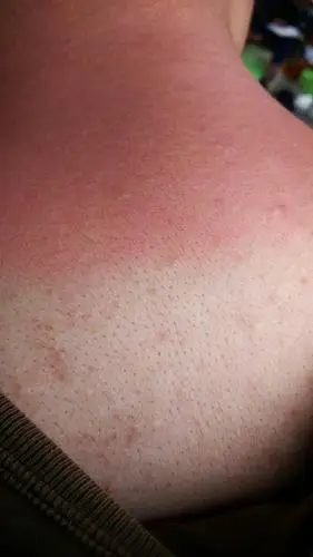 脖子就这样了.这是什么,我并不觉得我有过敏