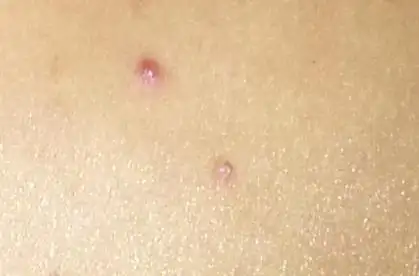 抹了很久的硫磺药膏了背上的是疥疮吗?