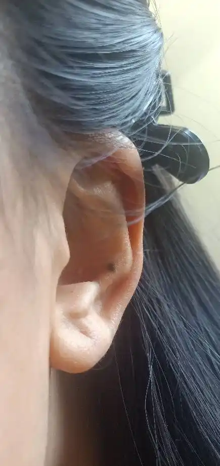左耳耳廓长大后长痣,感觉长大了,如图,请问会不会有健康问题,没有任何